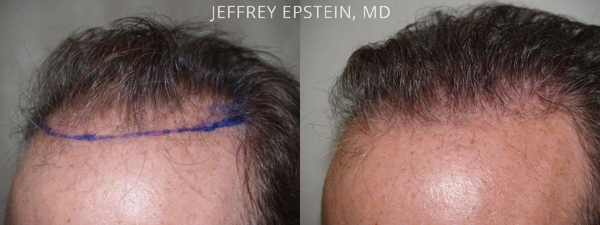 Hair Transplants for Men Before and after in Miami, FL, Paciente 39522