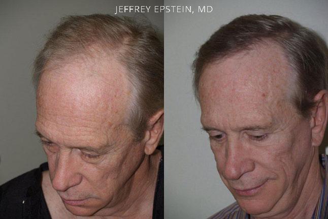 Hair Transplants for Men Before and after in Miami, FL, Paciente 39534