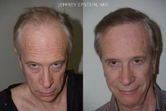 Hair Transplants for Men Before and after in Miami, FL, Paciente 39534