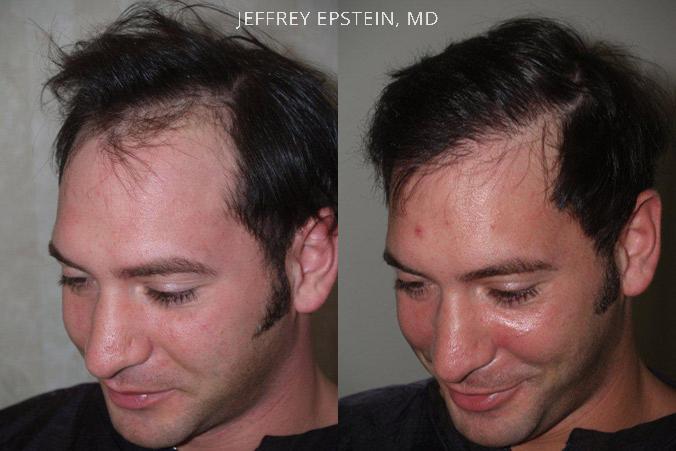 Trasplante de Pelo en Hombres Antes y después en Miami, FL, Paciente 78701