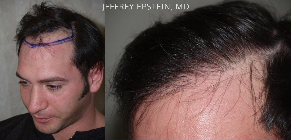 Hair Transplants for Men Before and after in Miami, FL, Paciente 39542