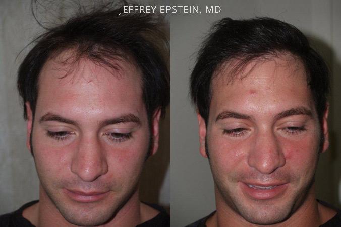 Trasplante de Pelo en Hombres Antes y después en Miami, FL, Paciente 78701