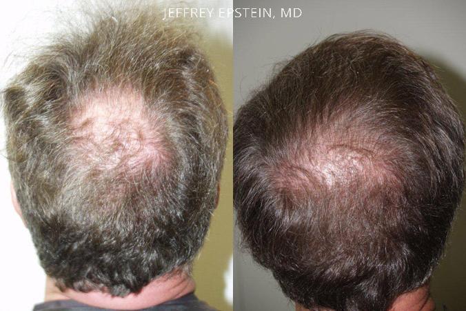 Hair Transplants for Men Before and after in Miami, FL, Paciente 39550