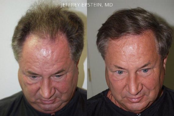 Hair Transplants for Men Before and after in Miami, FL, Paciente 39550