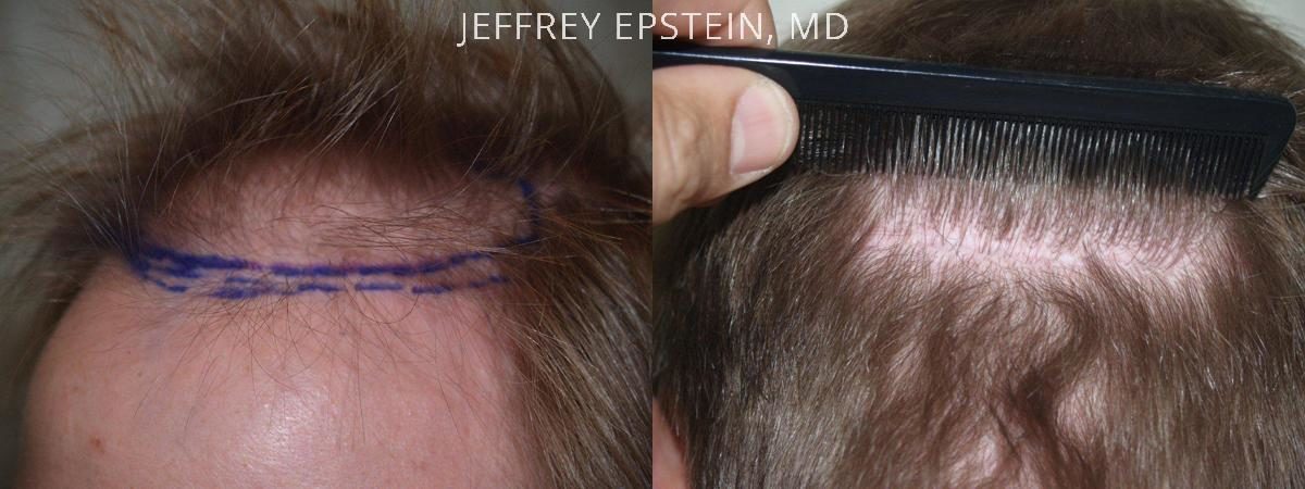 Hair Transplants for Men Before and after in Miami, FL, Paciente 39558