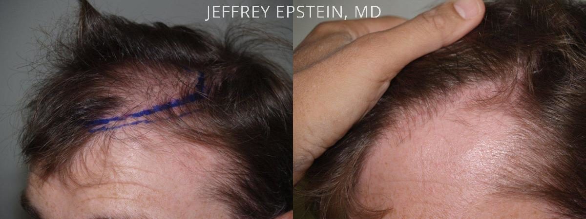 Hair Transplants for Men Before and after in Miami, FL, Paciente 39567