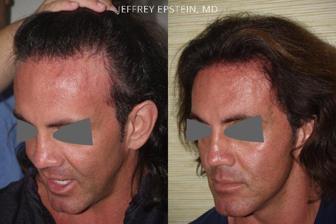 Hair Transplants for Men Before and after in Miami, FL, Paciente 39574