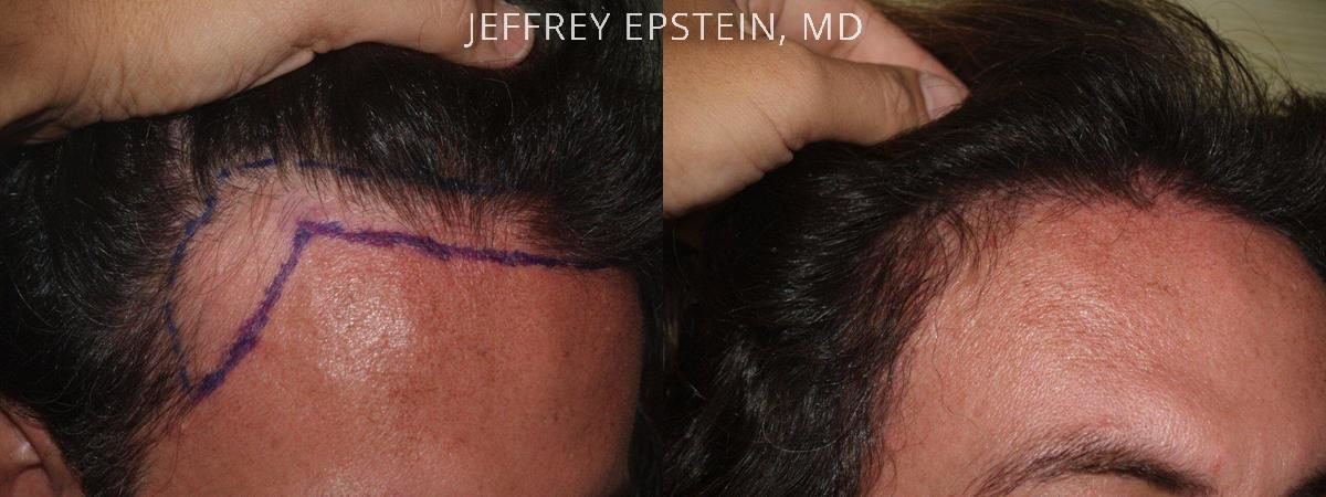 Hair Transplants for Men Before and after in Miami, FL, Paciente 39574