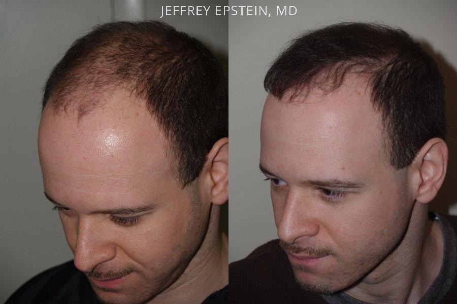 Hair Transplants for Men Before and after in Miami, FL, Paciente 39581