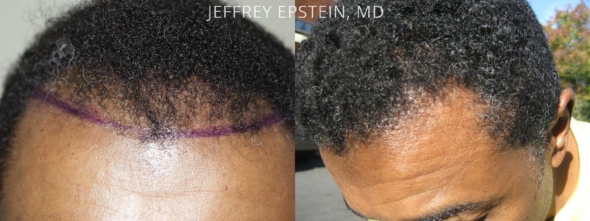 Hair Transplants for Men Before and after in Miami, FL, Paciente 39590