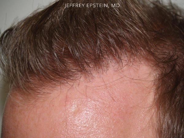 Hair Transplants for Men Before and after in Miami, FL, Paciente 39595