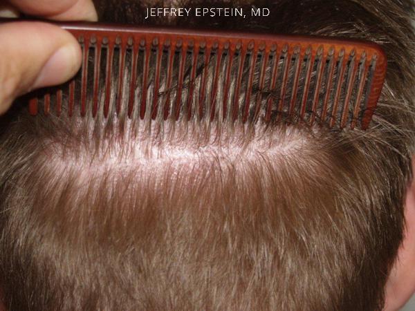 Hair Transplants for Men Before and after in Miami, FL, Paciente 39595
