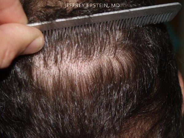 Hair Transplants for Men Before and after in Miami, FL, Paciente 39607