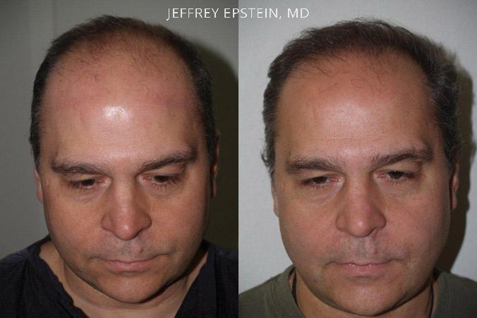 Hair Transplants for Men Before and after in Miami, FL, Paciente 39607