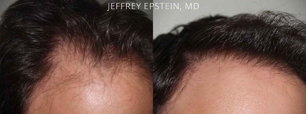 Hair Transplants for Men Before and after in Miami, FL, Paciente 39615