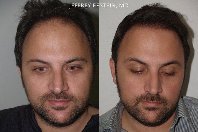Hair Transplants for Men Before and after in Miami, FL, Paciente 39615