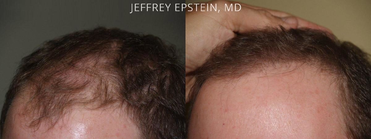 Hair Transplants for Men Before and after in Miami, FL, Paciente 39622