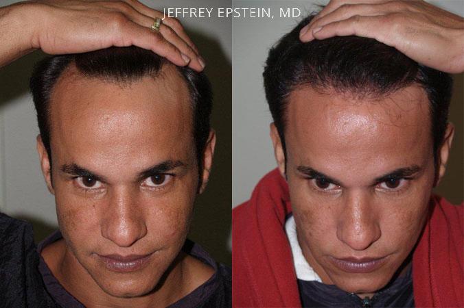 Hair Transplants for Men Before and after in Miami, FL, Paciente 39627