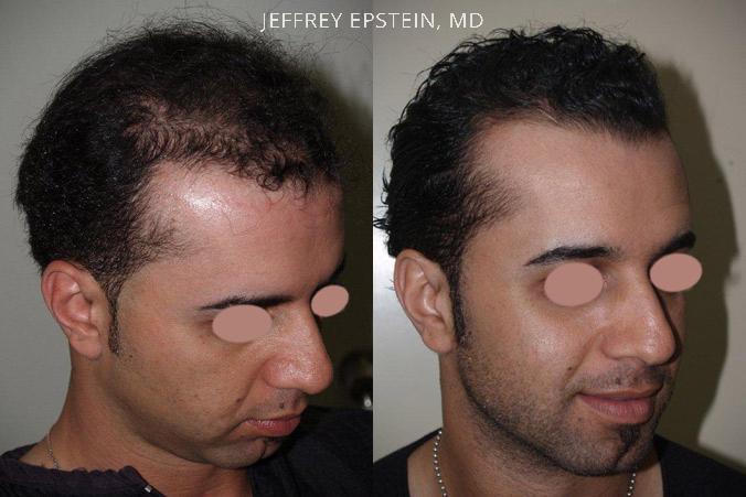 Hair Transplants for Men Before and after in Miami, FL, Paciente 39634