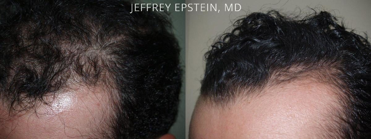 Hair Transplants for Men Before and after in Miami, FL, Paciente 39634
