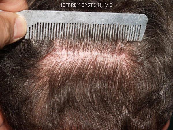 Hair Transplants for Men Before and after in Miami, FL, Paciente 39643