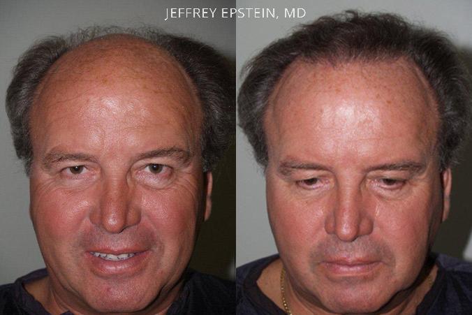 Hair Transplants for Men Before and after in Miami, FL, Paciente 39643