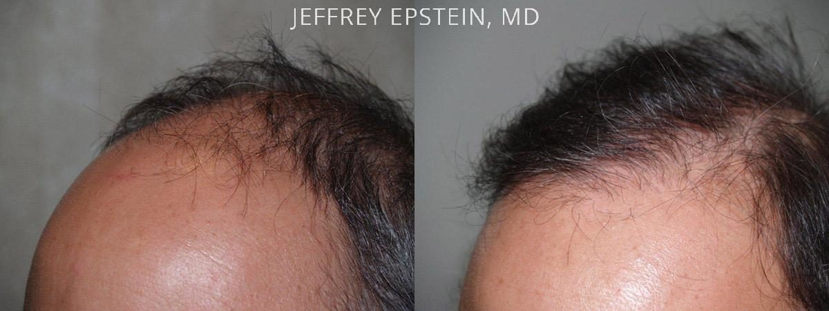 Hair Transplants for Men Before and after in Miami, FL, Paciente 39649