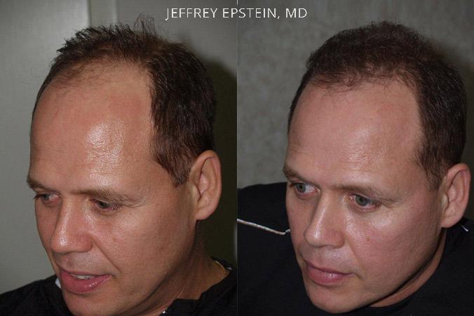 Trasplante de Pelo en Hombres Antes y después en Miami, FL, Paciente 78156