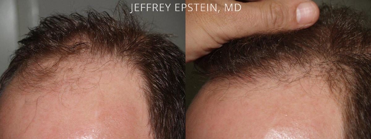 Hair Transplants for Men Before and after in Miami, FL, Paciente 39656