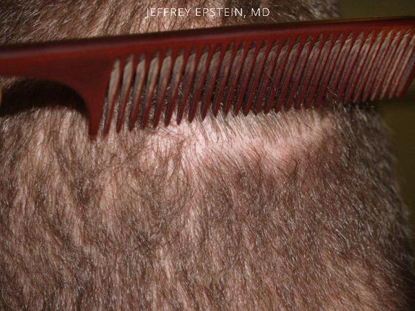 Hair Transplants for Men Before and after in Miami, FL, Paciente 39664
