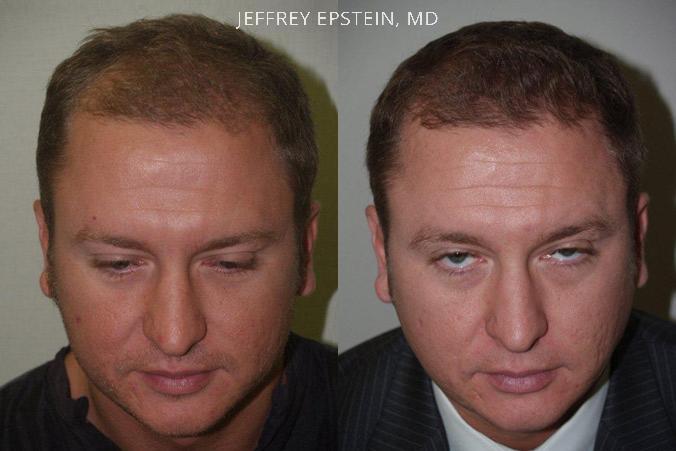 Hair Transplants for Men Before and after in Miami, FL, Paciente 39664