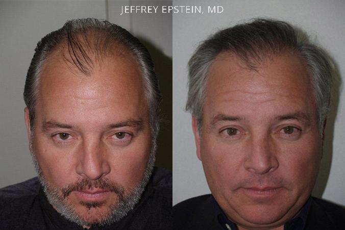 Hair Transplants for Men Before and after in Miami, FL, Paciente 39670