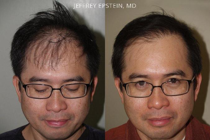 Hair Transplants for Men Before and after in Miami, FL, Paciente 39680