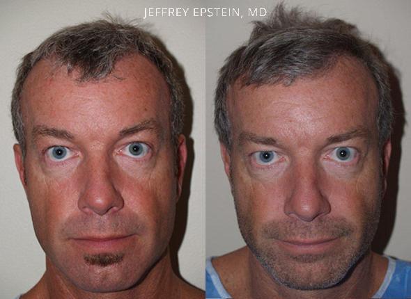 Hair Transplants for Men Before and after in Miami, FL, Paciente 39687