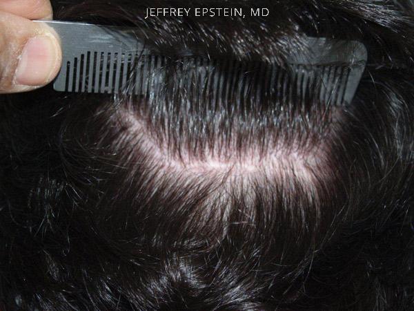 Hair Transplants for Men Before and after in Miami, FL, Paciente 39700