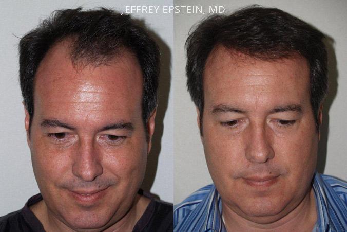 Trasplante de Pelo en Hombres Antes y después en Miami, FL, Paciente 77947