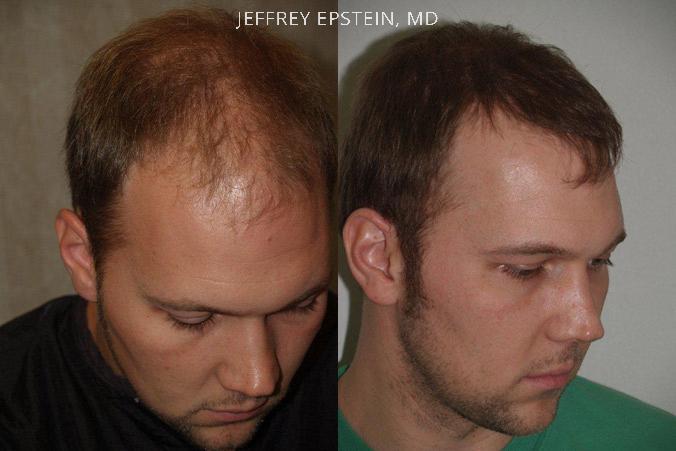Hair Transplants for Men Before and after in Miami, FL, Paciente 39708