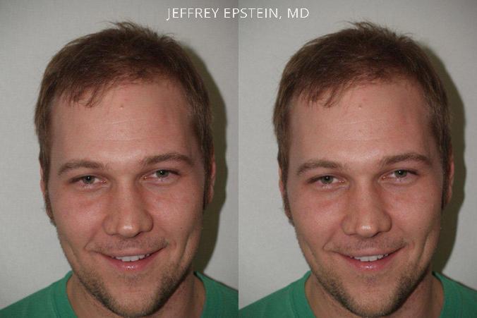 Trasplante de Pelo en Hombres Antes y después en Miami, FL, Paciente 77916