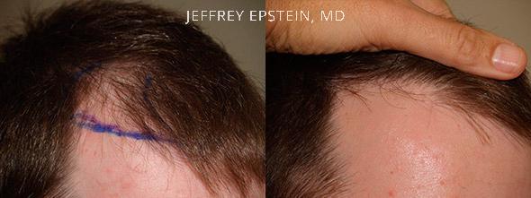 Hair Transplants for Men Before and after in Miami, FL, Paciente 39715