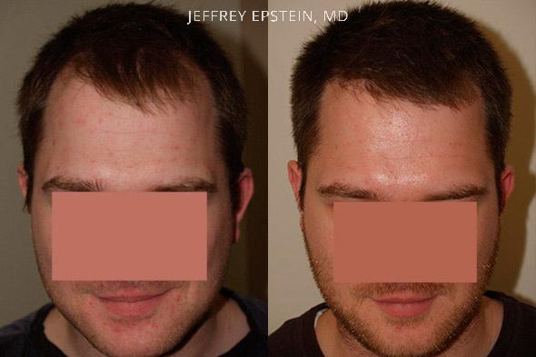 Hair Transplants for Men Before and after in Miami, FL, Paciente 39715