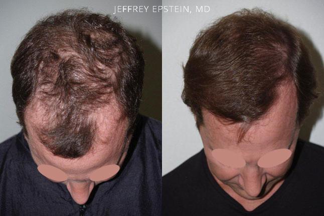 Hair Transplants for Men Before and after in Miami, FL, Paciente 39722