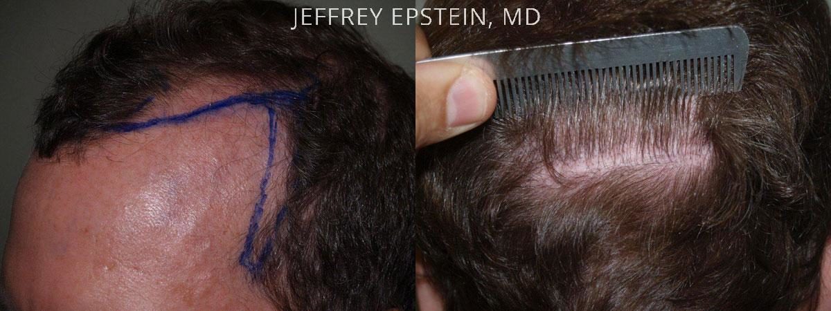 Hair Transplants for Men Before and after in Miami, FL, Paciente 39722