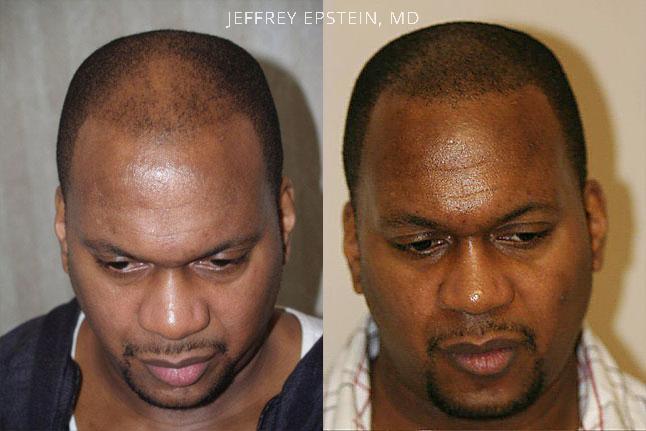 Hair Transplants for Men Before and after in Miami, FL, Paciente 39731