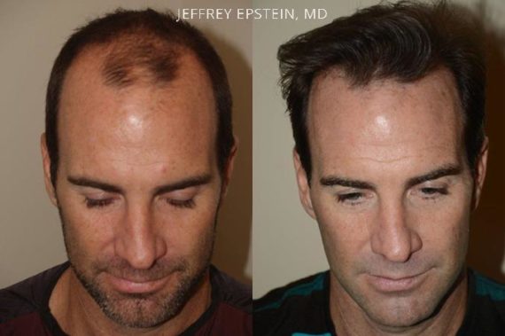 Hair Transplants for Men Before and after in Miami, FL, Paciente 39737