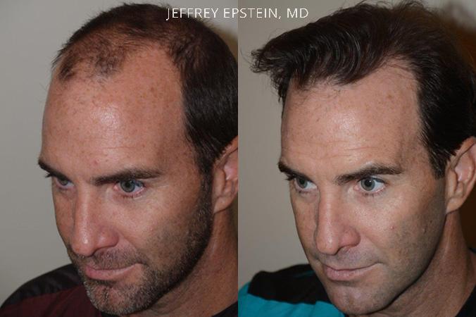 Hair Transplants for Men Before and after in Miami, FL, Paciente 39737