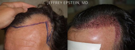 Hair Transplants for Men Before and after in Miami, FL, Paciente 39753
