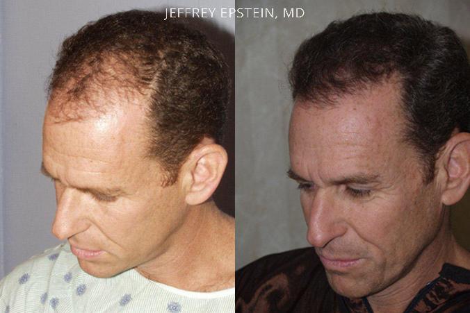 Trasplante de Pelo en Hombres Antes y después en Miami, FL, Paciente 77694