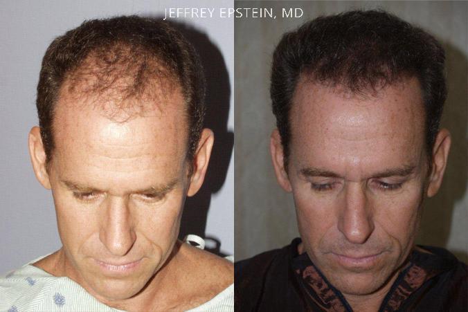 Trasplante de Pelo en Hombres Antes y después en Miami, FL, Paciente 77694