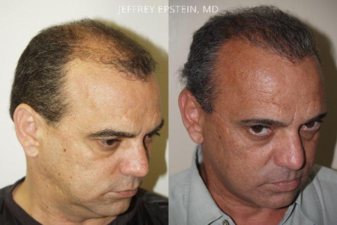 Trasplante de Pelo en Hombres Antes y después en Miami, FL, Paciente 77624