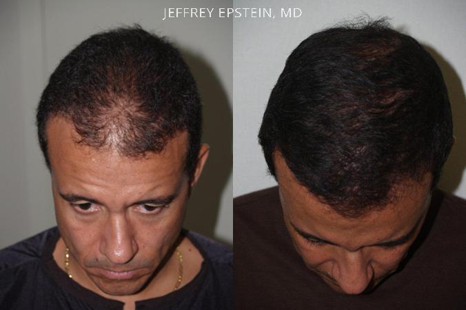 Hair Transplants for Men Before and after in Miami, FL, Paciente 39778